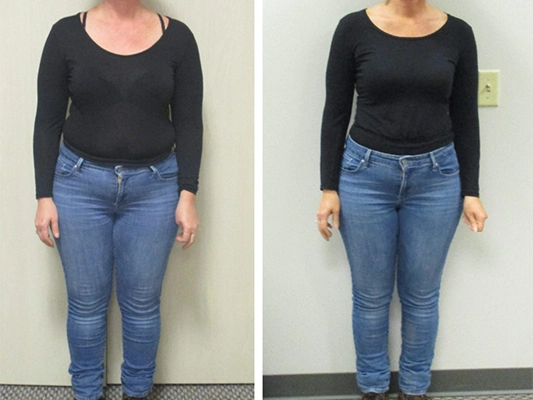 Weight Loss St. Louis MO Before And After