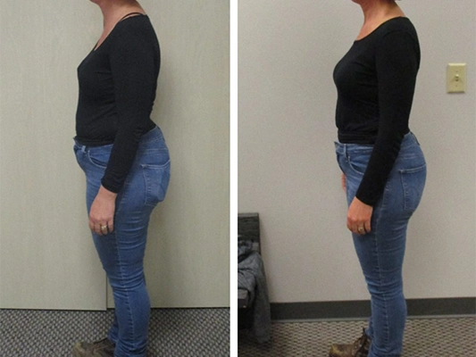 Weight Loss St. Louis MO Before And After