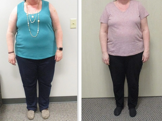 Weight Loss St. Louis MO Before And After