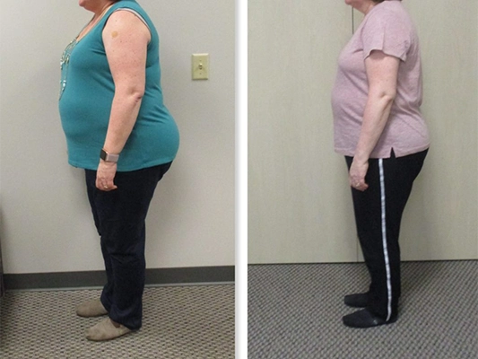 Weight Loss St. Louis MO Before And After